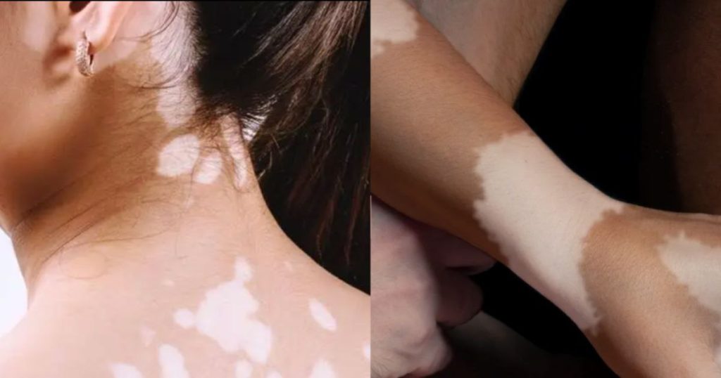 Vitiligo FI2